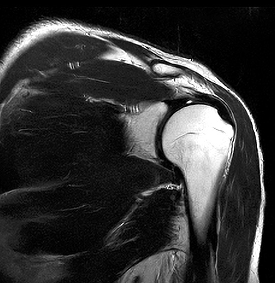 Shoulder Coronal MRI Scan (Enhanced AI)